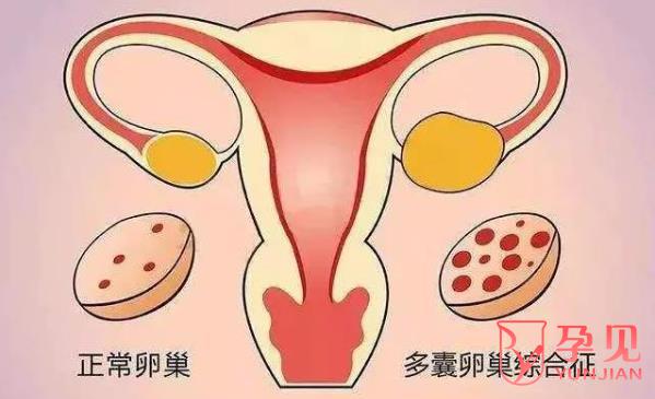 多囊卵巢综合征怎么治疗才能彻底好