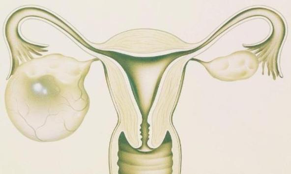 多囊卵巢综合症怎么调理才能好起来