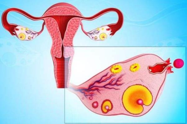 多囊卵巢综合症是很严重的病吗