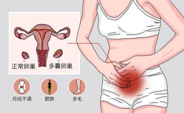 多囊卵巢综合征是什么原因导致的