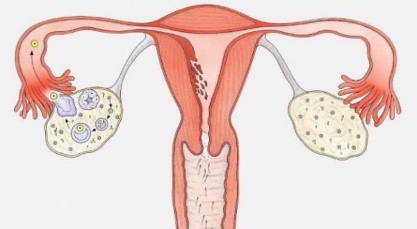 多囊卵巢综合征是什么