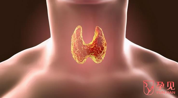 甲状腺早期的10个征兆是什么