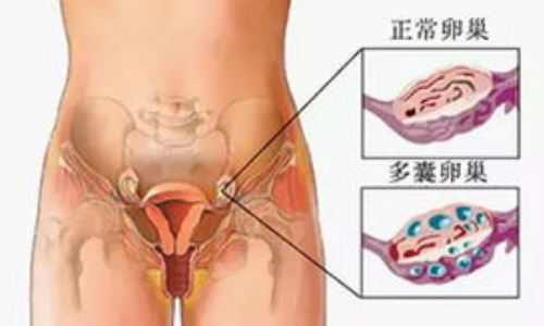 多囊卵巢吃黄体酮可以吗，多囊治疗方法