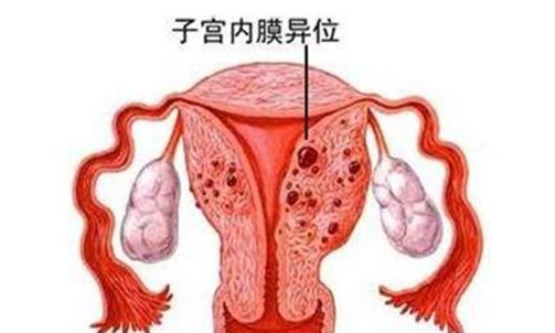 子宫内膜异位症有哪些症状
