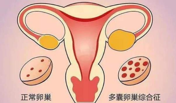 多囊卵巢是卵巢功能不好吗