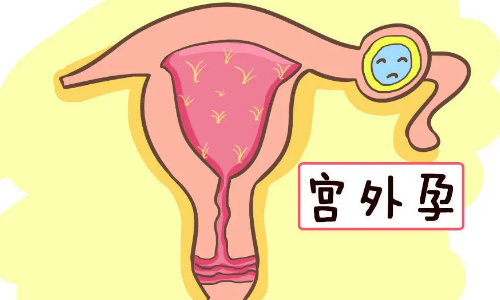 宫外孕的原因，做试管能避免吗