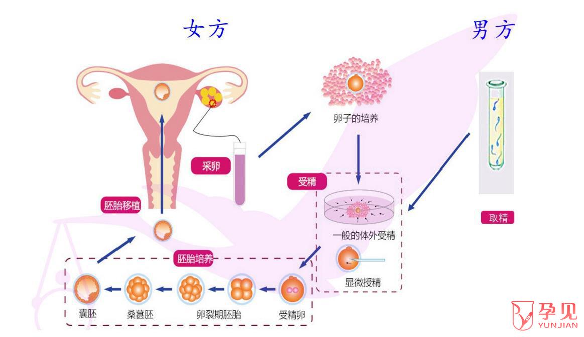 胚胎移植过程详细介绍